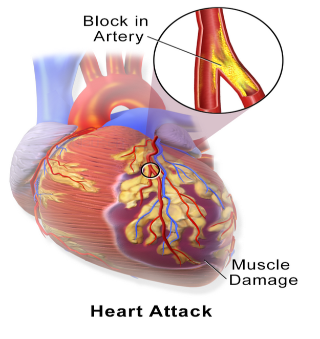  أسباب الجلطة القلبية 
